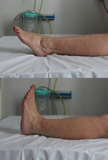 Preparation for your short stay hip replacement | North Bristol NHS Trust